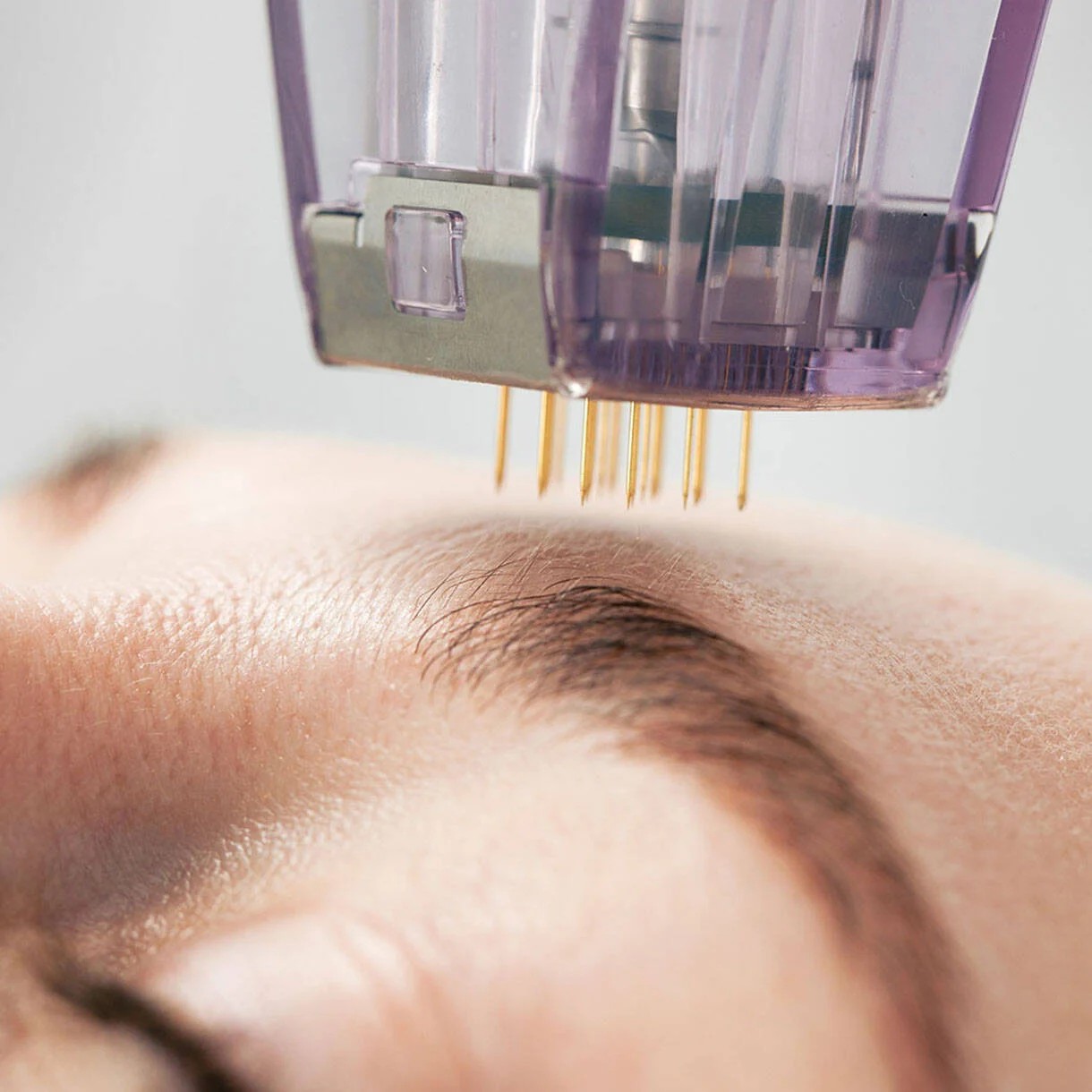 Morpheus8 RF microneedling