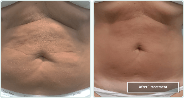 Abdomen & Flanks