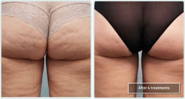 Buttocks & Thighs