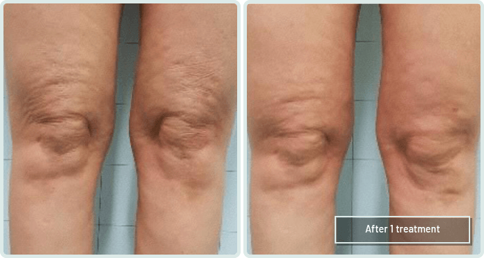 Knees